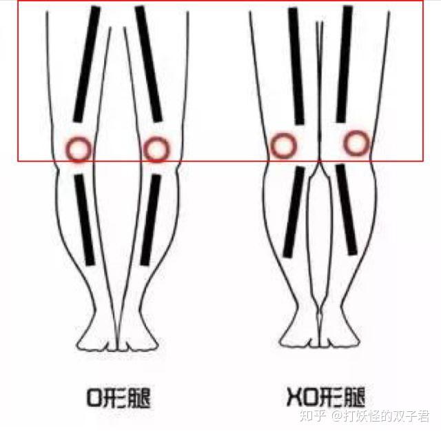 乾貨腿彎腿不直x型o型腿的你到底應該怎麼穿