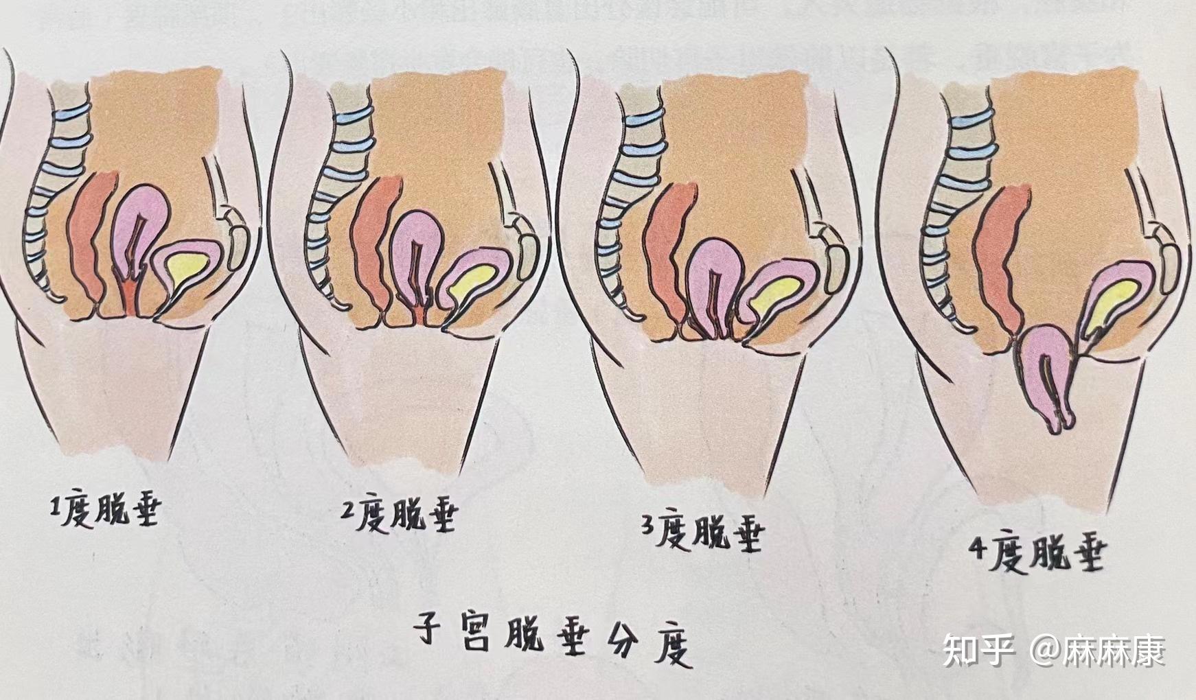 女性膀胱膨出图 子宫图片