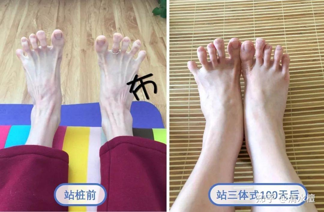 怎么让脚上肉变多?