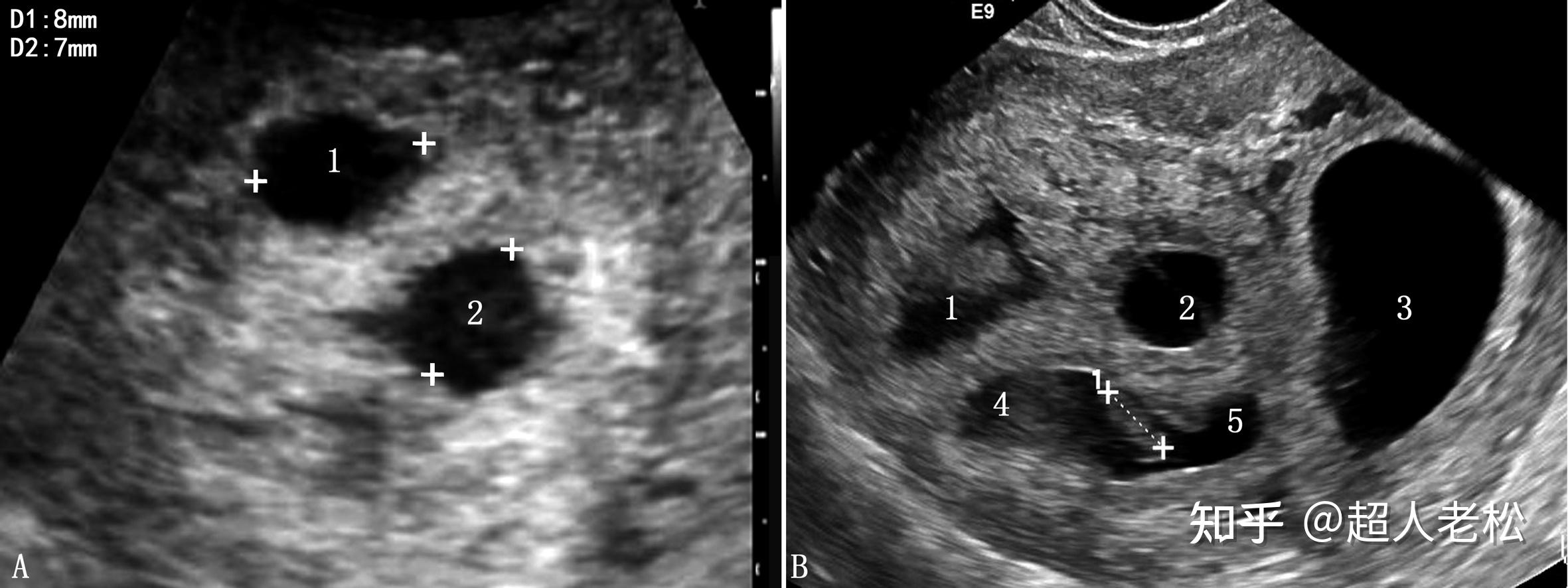 图7-ⅰ 早孕妊娠囊-临床医学-医学