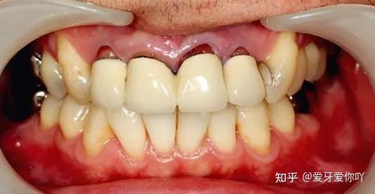 贵金属烤瓷牙咬合面窝沟黑褐色沉积? - 知乎