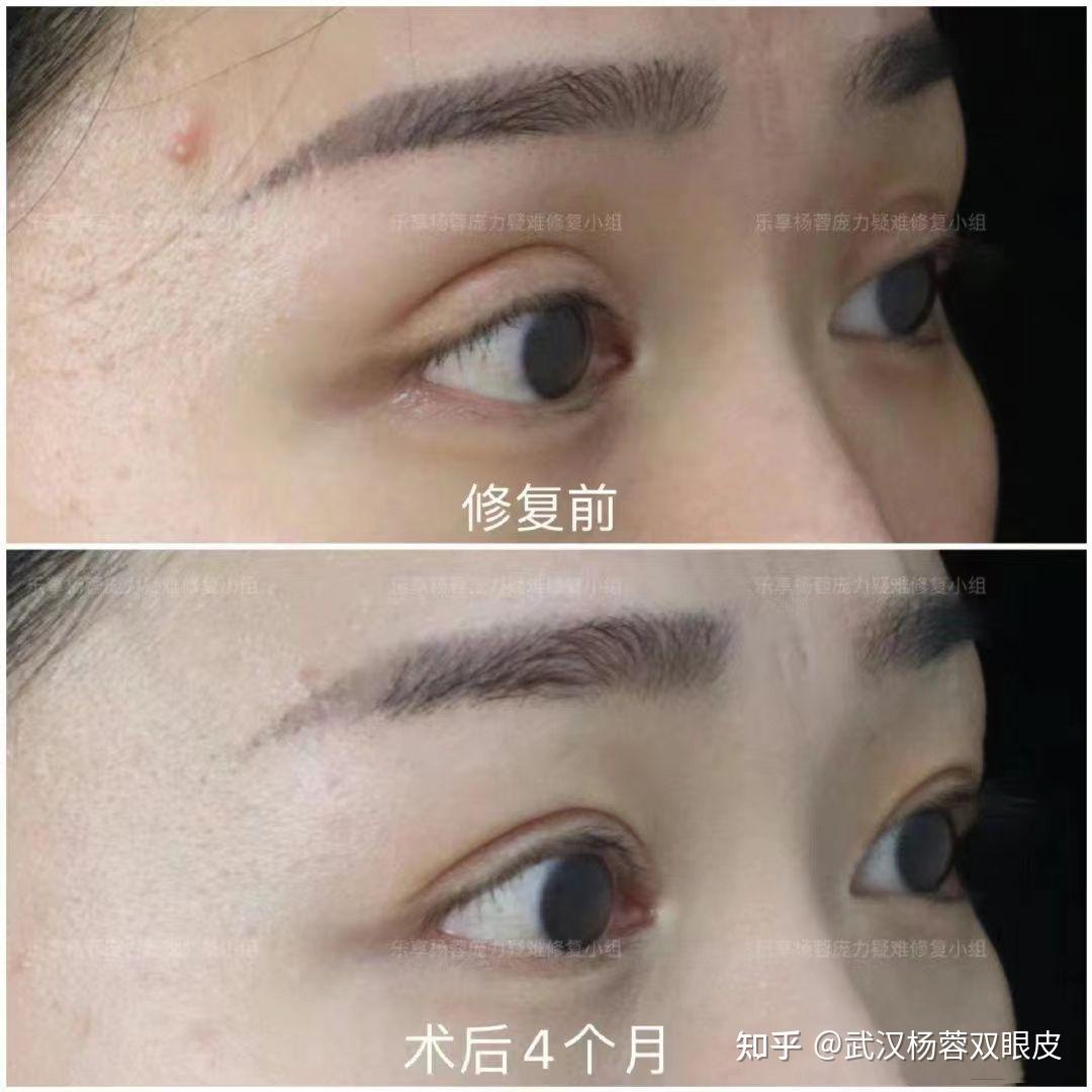 欧式大双眼皮修复后重回自然开扇