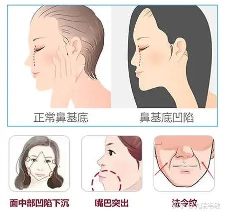 九院韦敏说,鼻基底凹陷与法令纹的关系 - 知乎