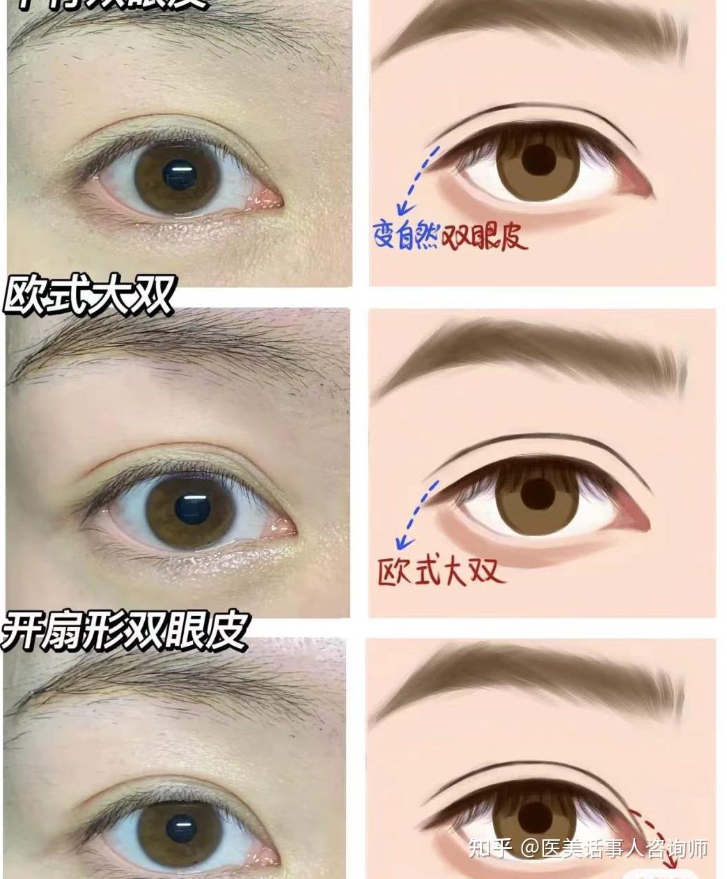 常见的四种双眼皮类型，哪款可以get到你呢？ - 知乎