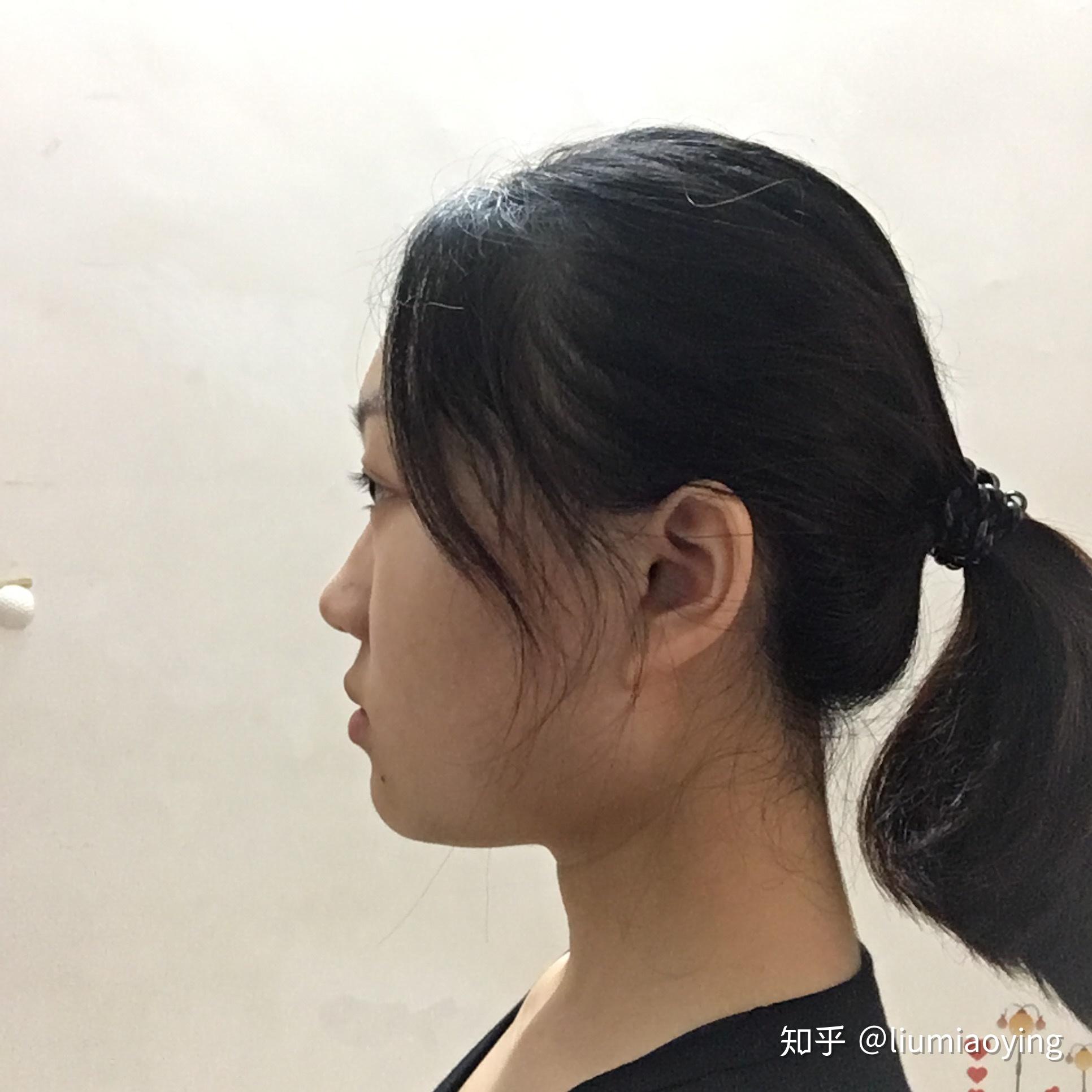 侧脸地包天(芒果脸,月亮脸,鞋拔子脸)是怎样的一种体验? - 知乎