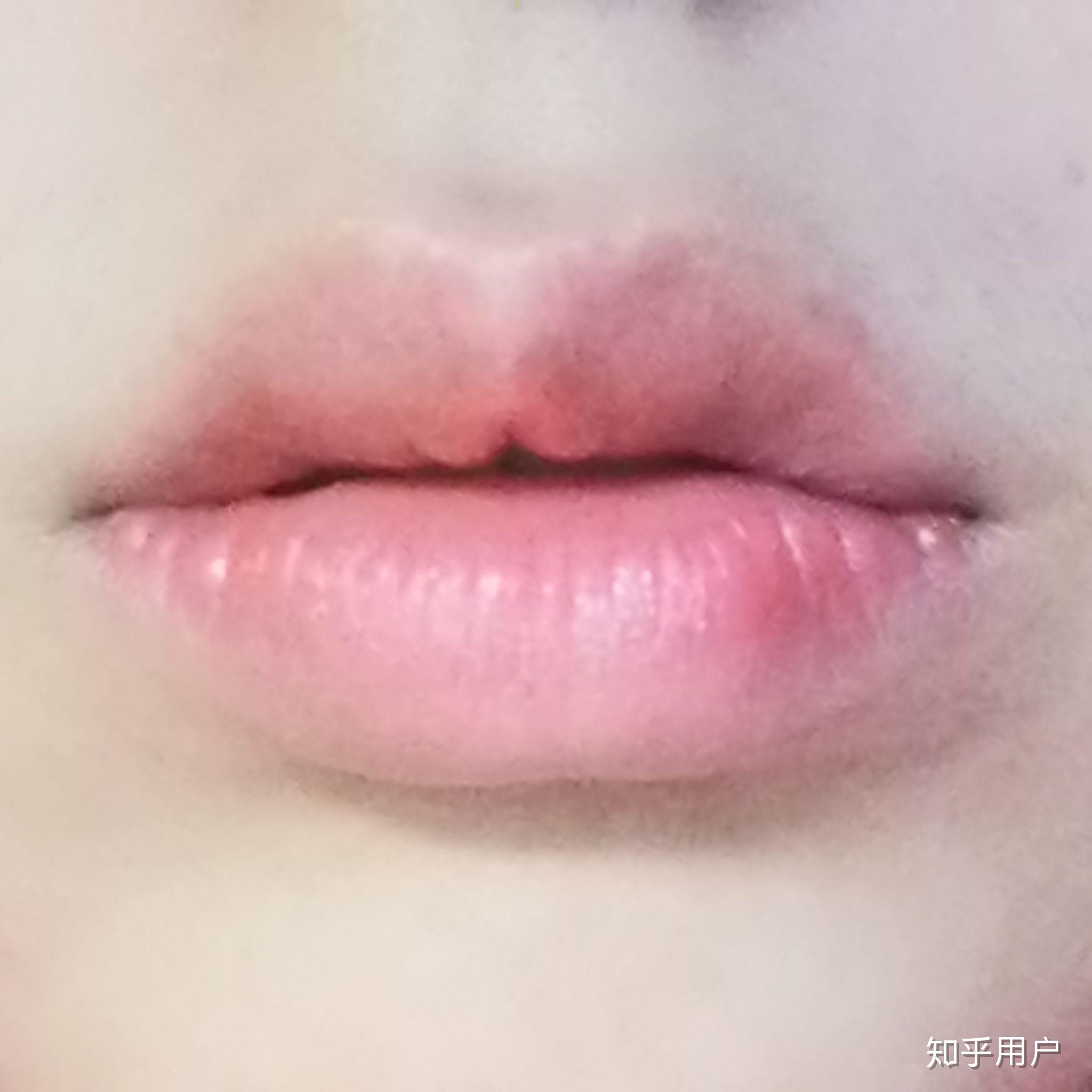 嘴唇很容易起皮经常咬结果本来长唇珠的位置凹进去一块怎么办