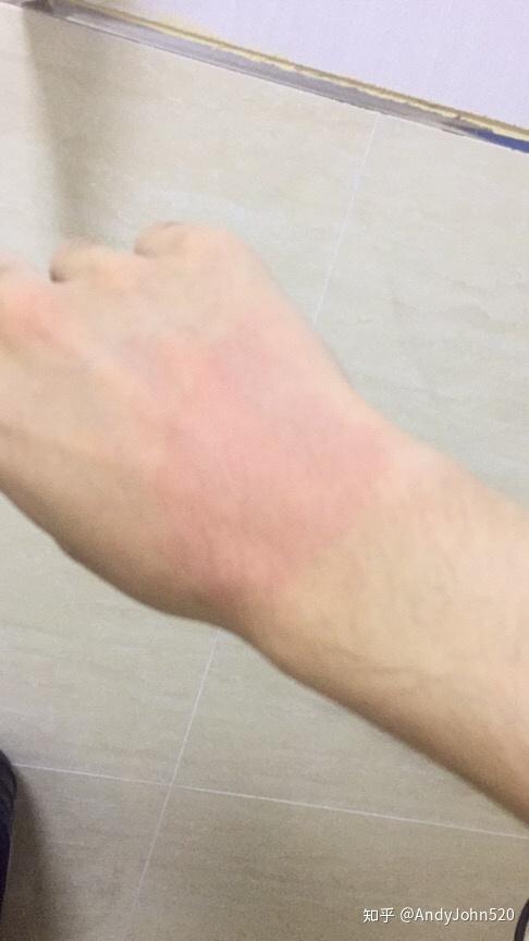 手被开水烫伤了怎么办