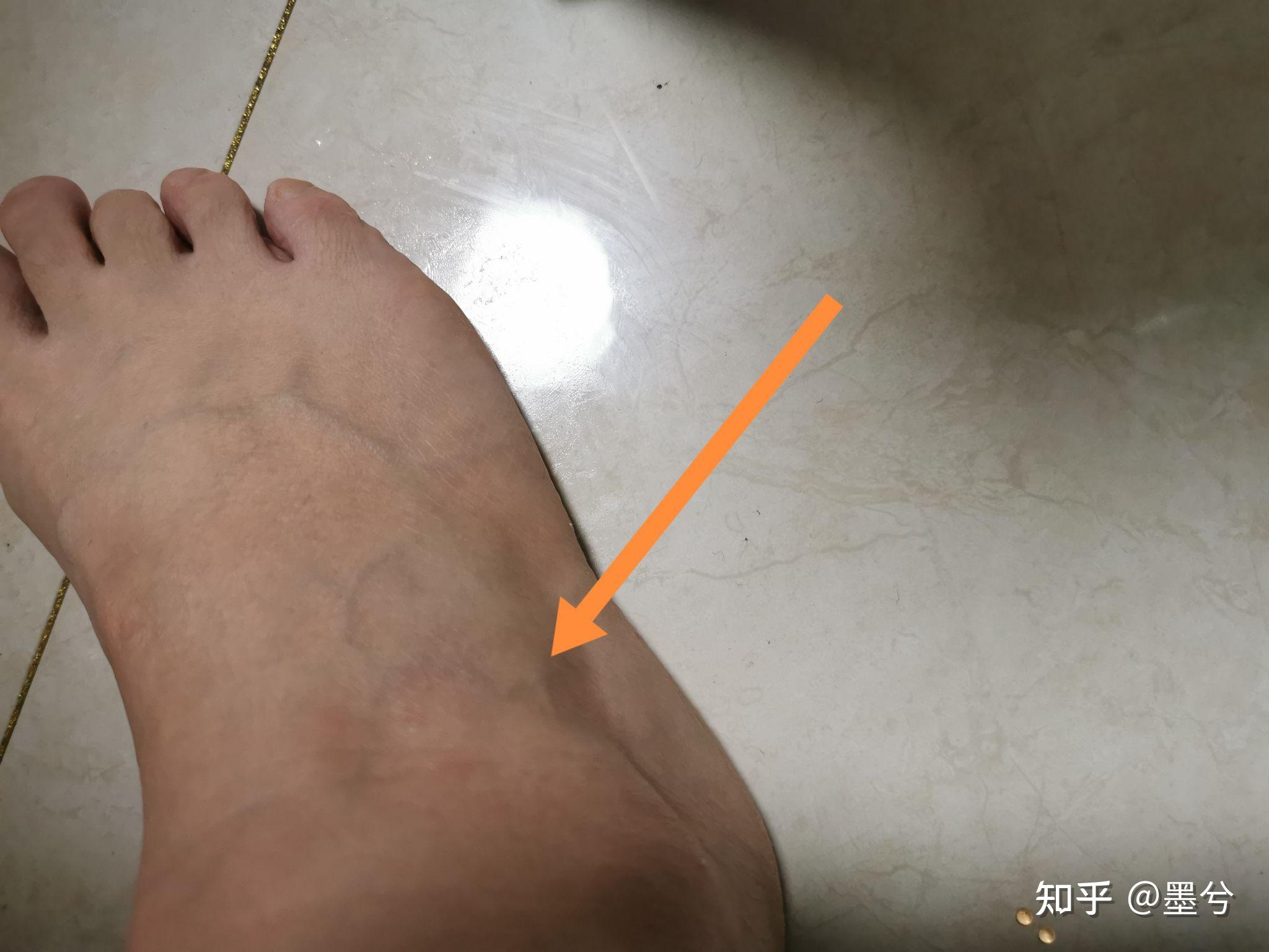 双踝双膝骨髓水肿前交叉韧带损伤