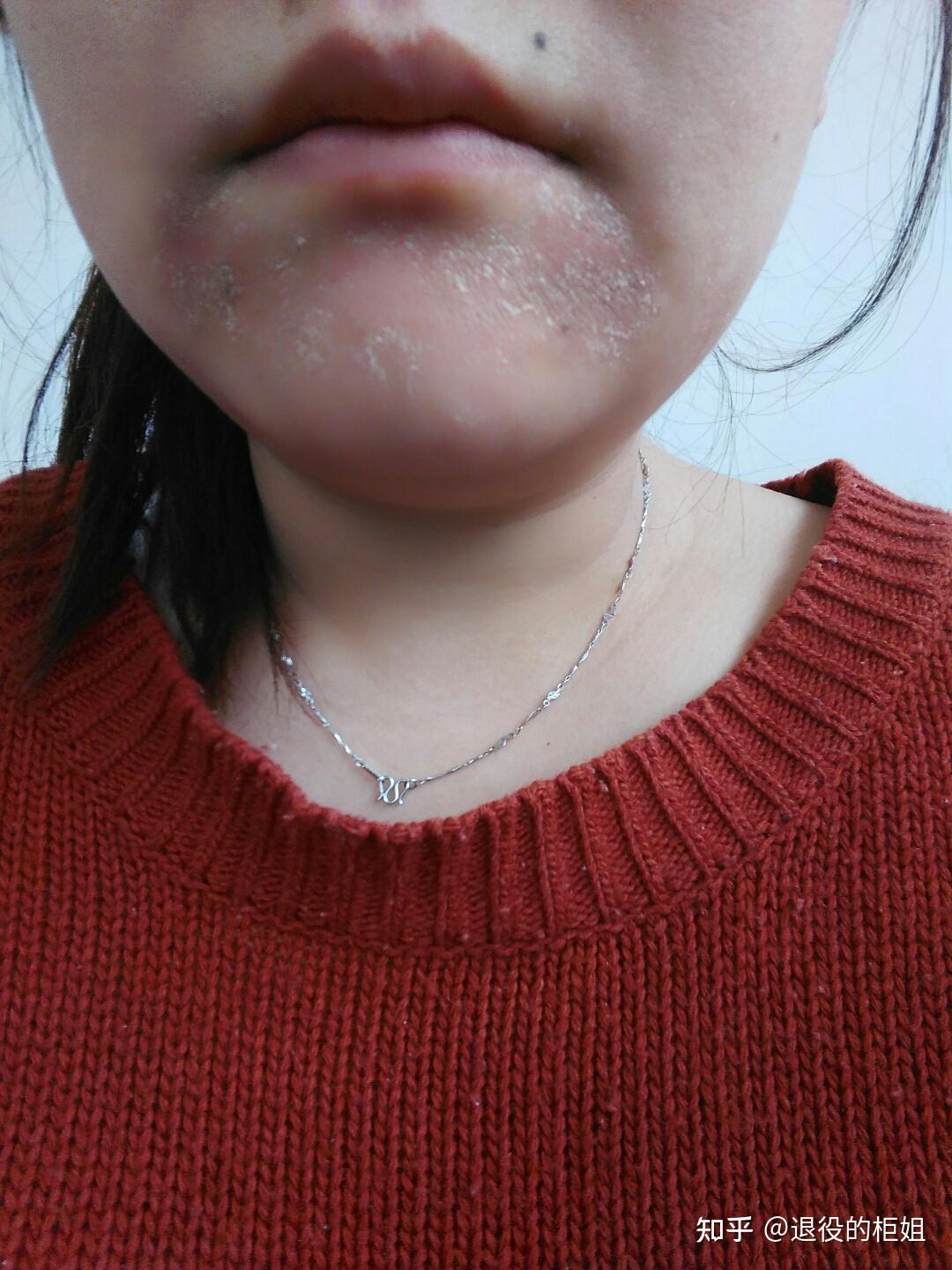 下巴起皮发红是什么原因? - 知乎