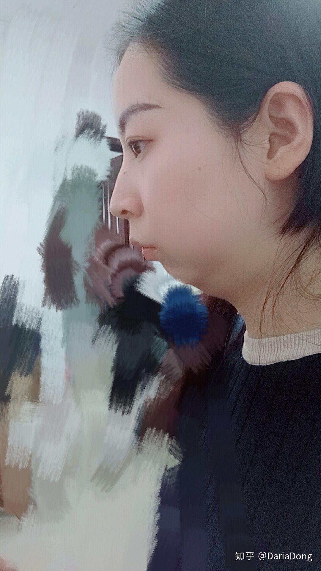 口呼吸面容成年后可以矫正吗