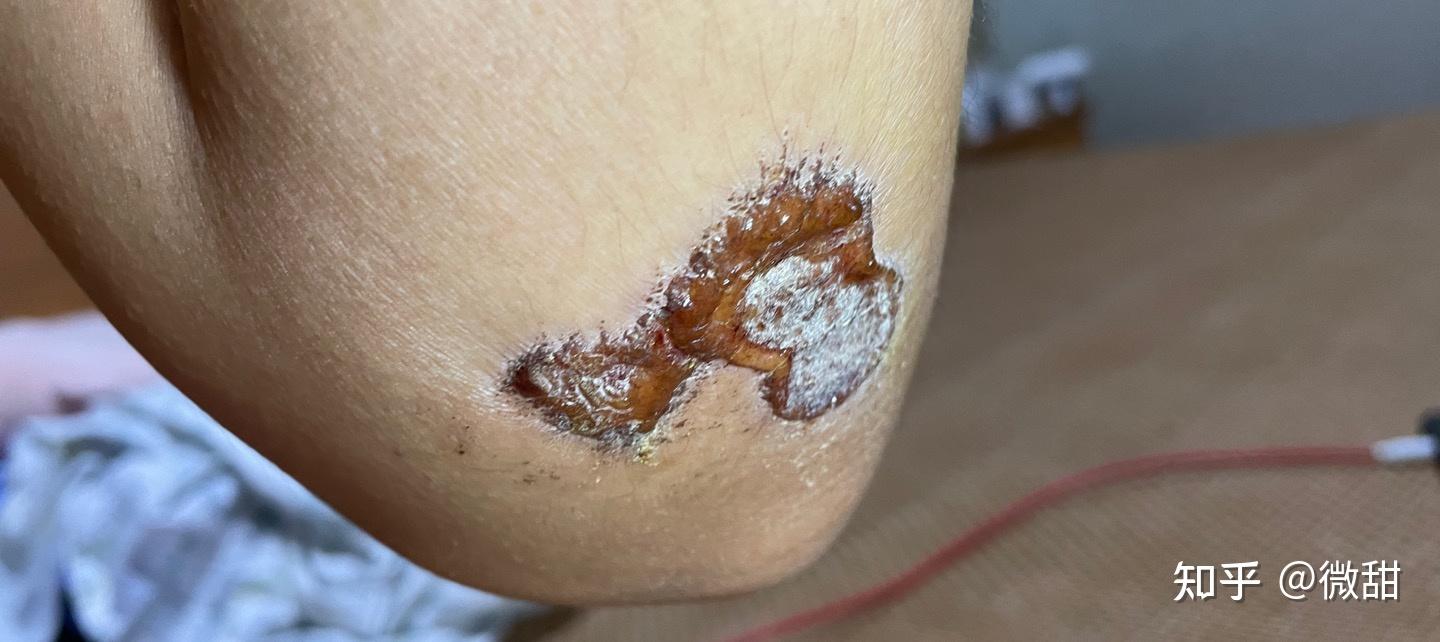 膝盖摔伤痛苦的回忆大佬们该怎么上药啊