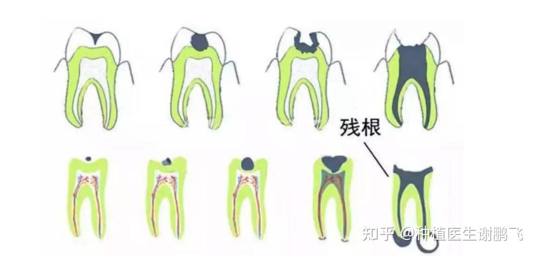 医生,我嘴巴只剩几个残根了,必须要拔掉吗? - 知乎