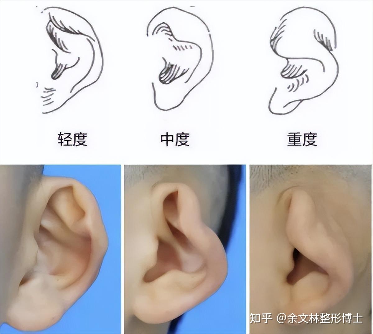 关于小耳畸形的再造——5D义耳赝复技术 - 知乎