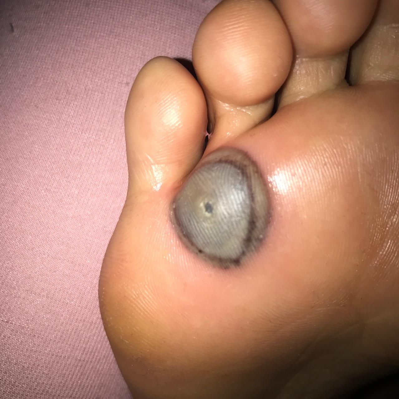 治疗手指上的寻常疣鱼鳞痣有什么办法或者药物