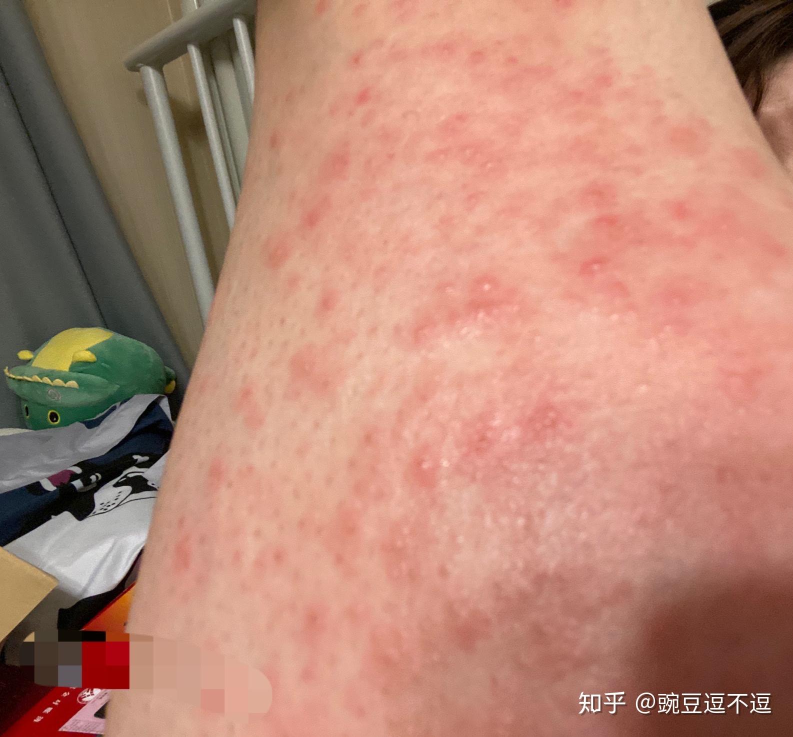 去医院检查得了疥疮擦了硫软膏后成这样了