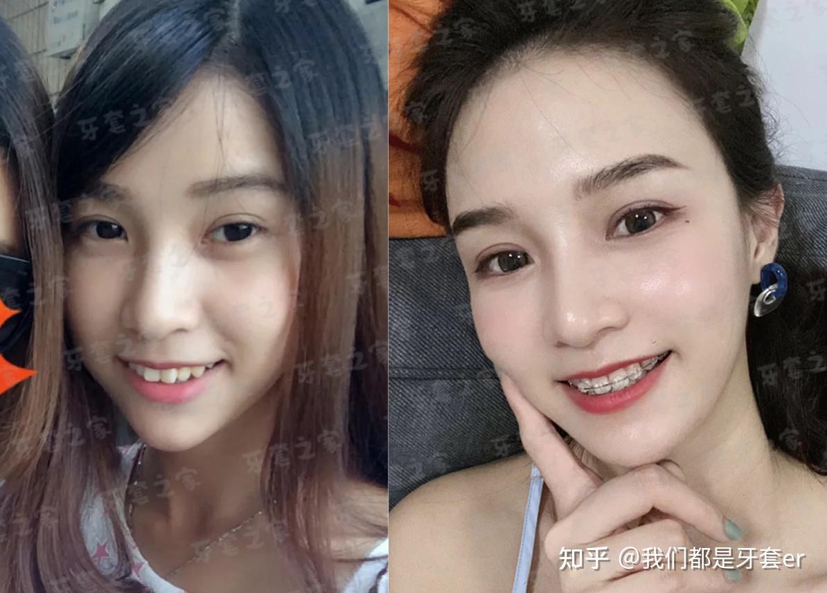 深覆合做矫正都要带平导吗? - 知乎