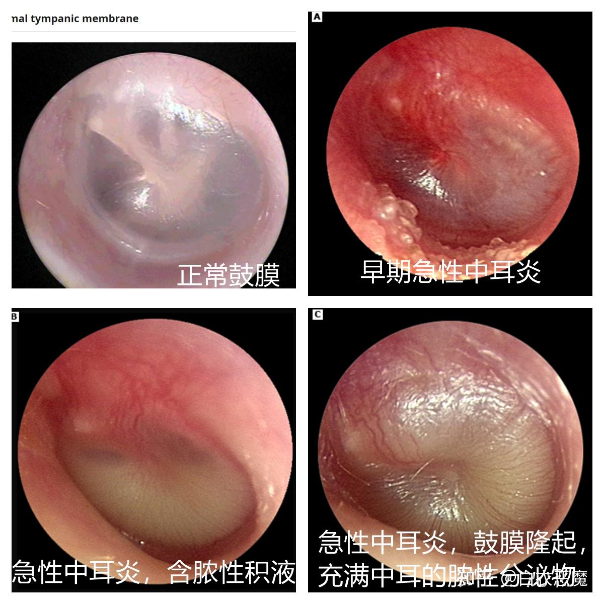 儿童急性中耳炎图片图片