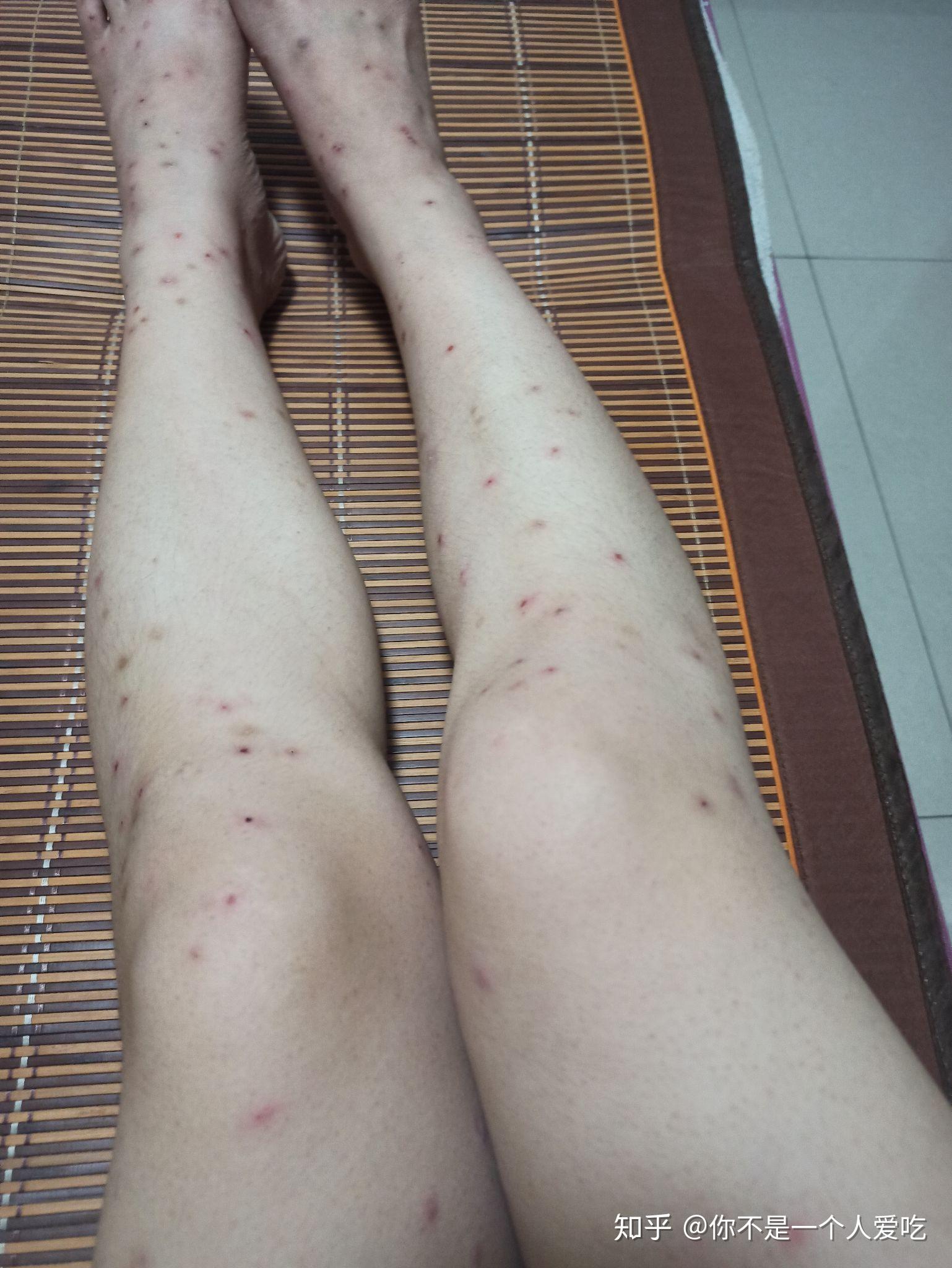 被飞蠓咬了很长时间没好,去了医院也没有很好的效果,有没有好的解决方