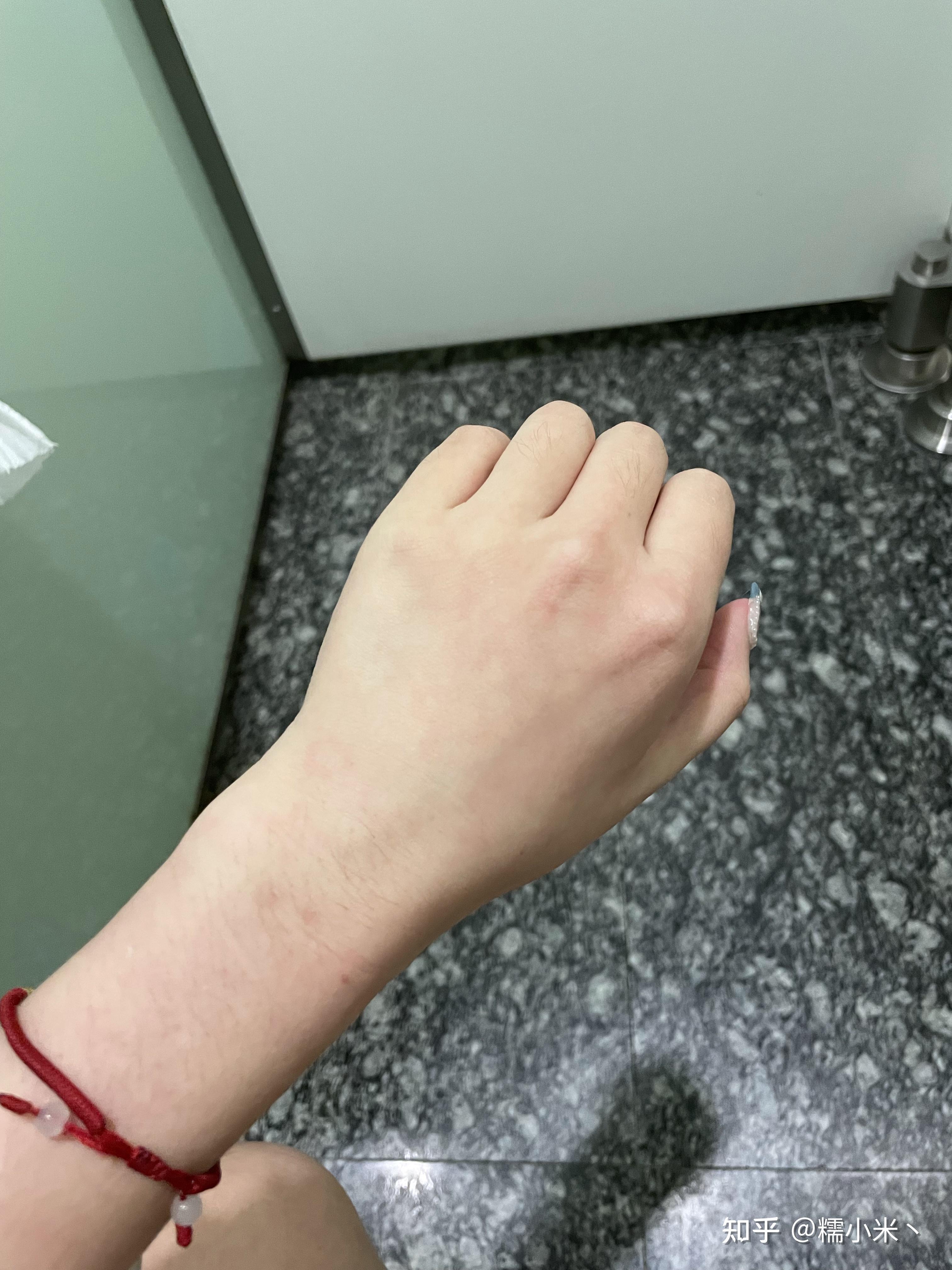 请问天冷时,手心手背都发乌发紫是为什么,是身体有什么问题吗?