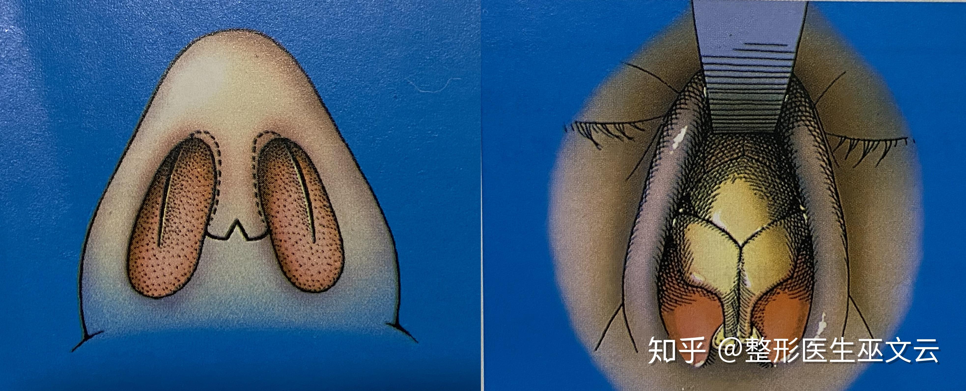 鼻整形选内切口还是外切口