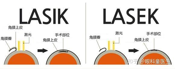 3,接下来是lasek,lasek(laser-assisted subepithelial
