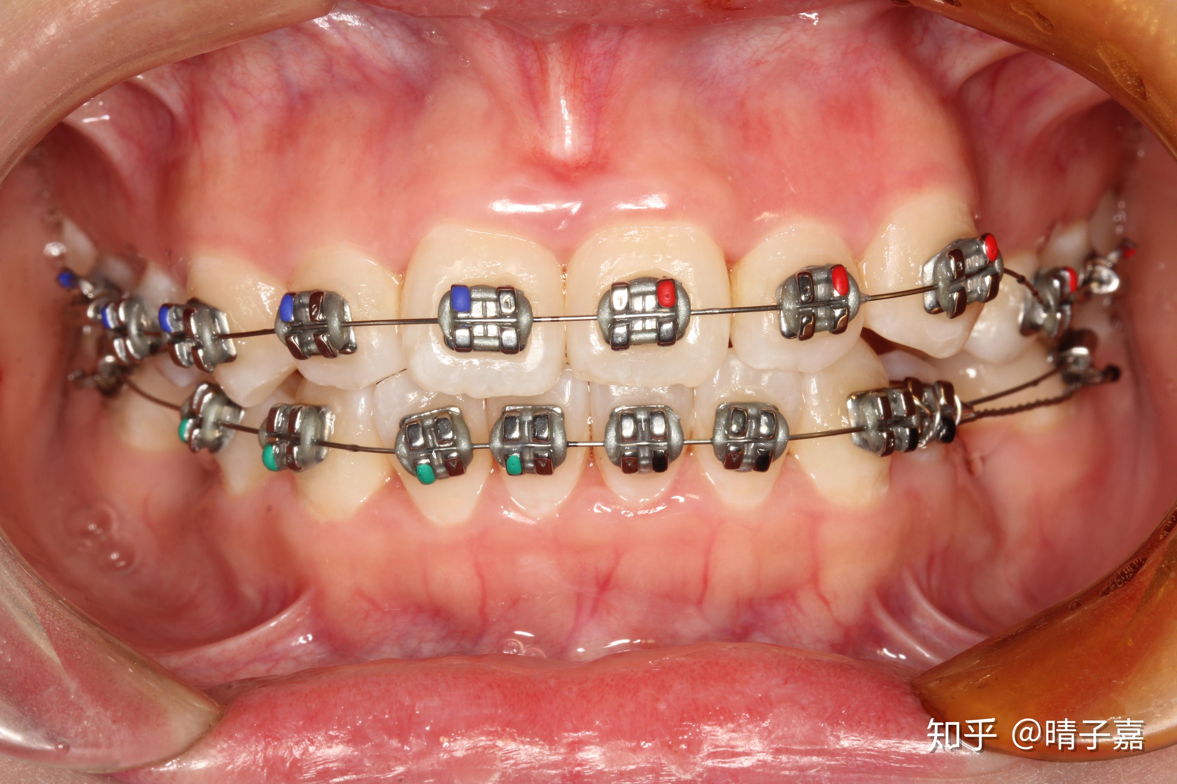 钢牙记口腔医学生做正畸的体验日记清洁图片记录个人感受