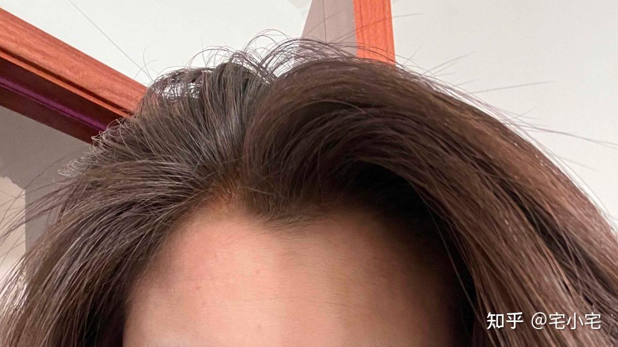 病理性脱发,认准米诺地尔