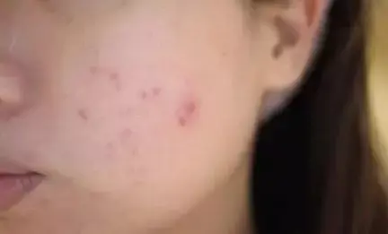 长痘痘和吃辣的有关系吗? - 知乎