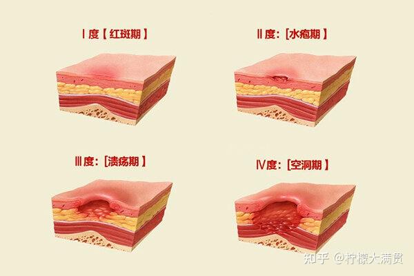 压疮怎么治? - 知乎