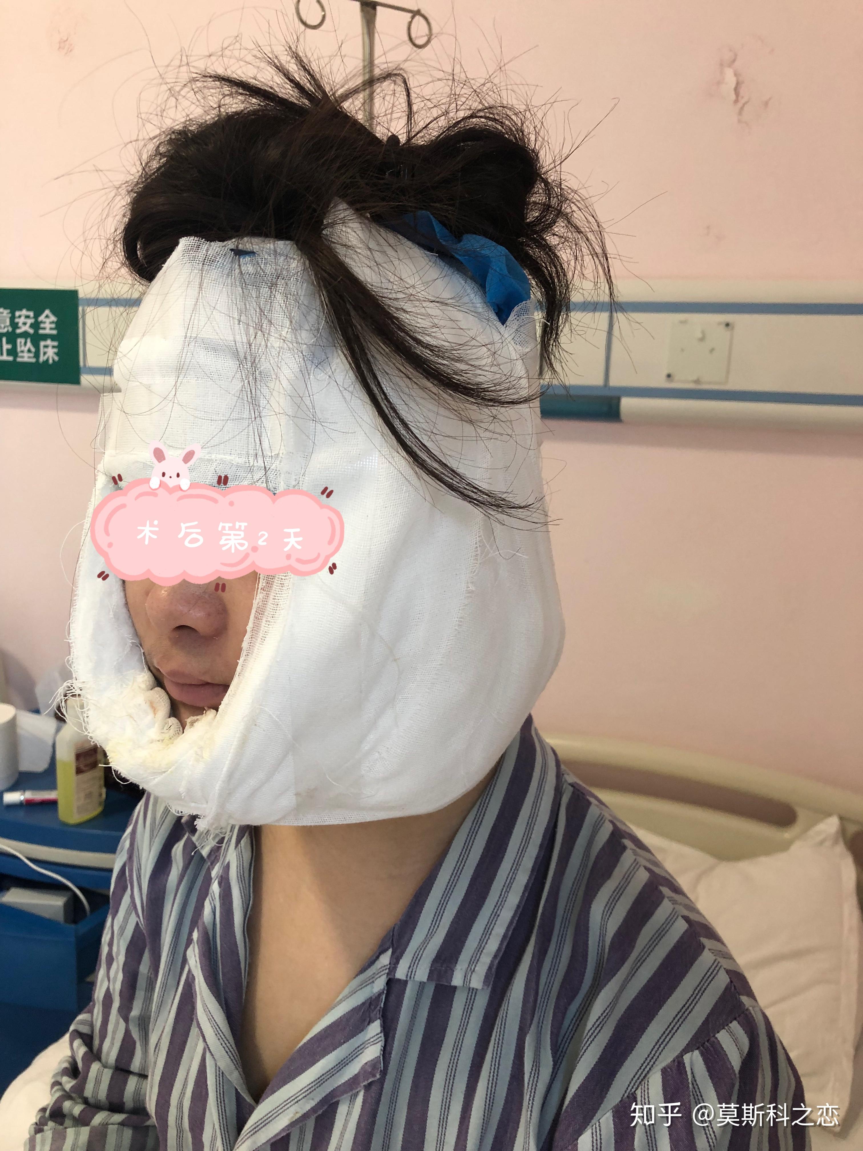 终于做了下颌角手术多年心愿圆满完成