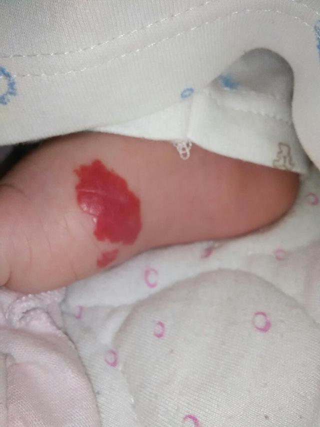 权威专家告诉你新生儿患血管瘤的原因,婴儿血管瘤初期图片一览 