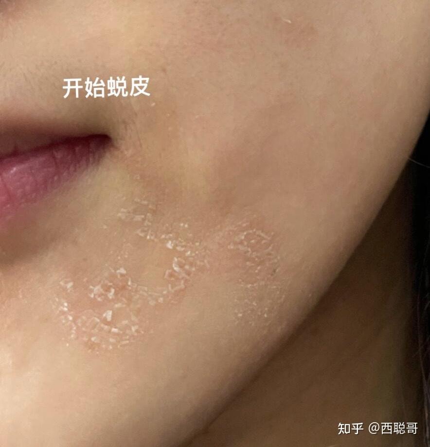 混油皮超级卡粉起皮浮粉怎么办有无护肤品推荐