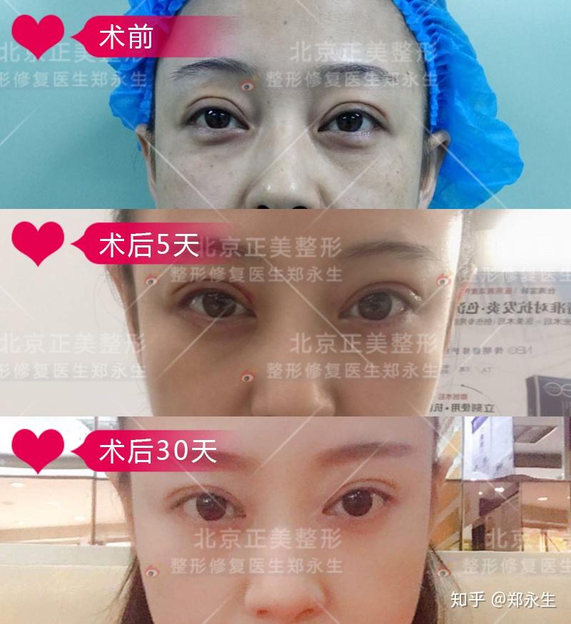 双眼皮修复案例