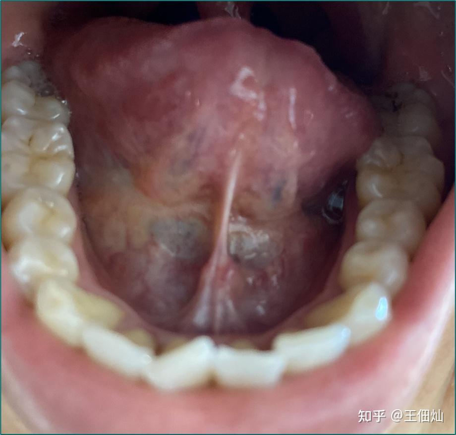 口内型舌下腺囊肿可以自愈