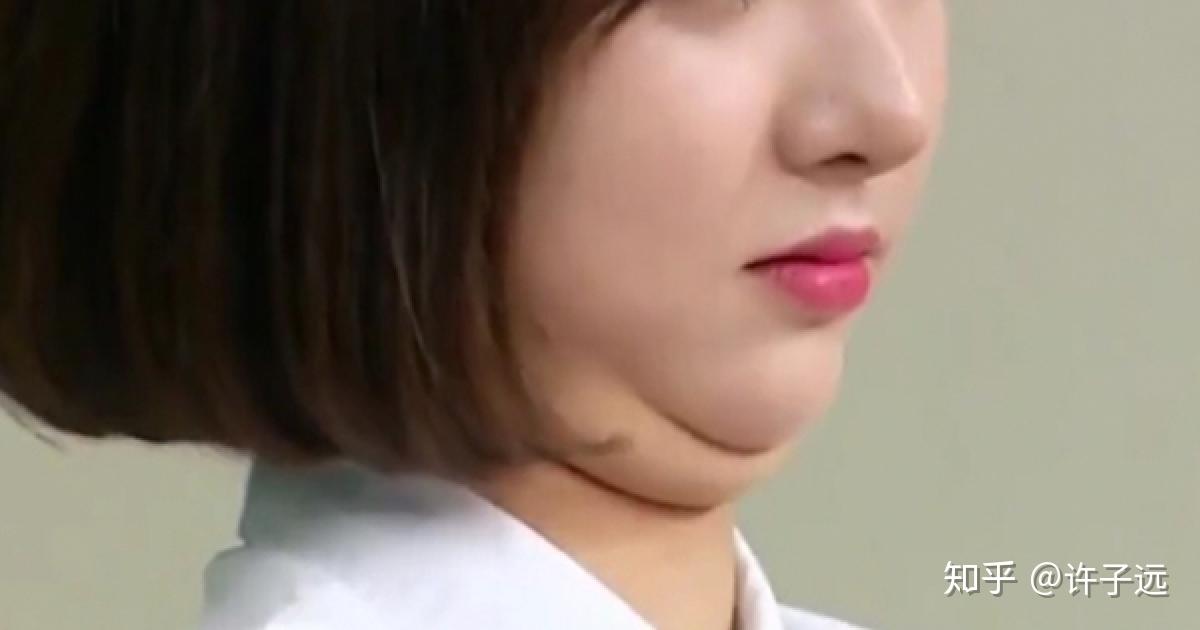 下巴后缩下巴短有哪些解决方法