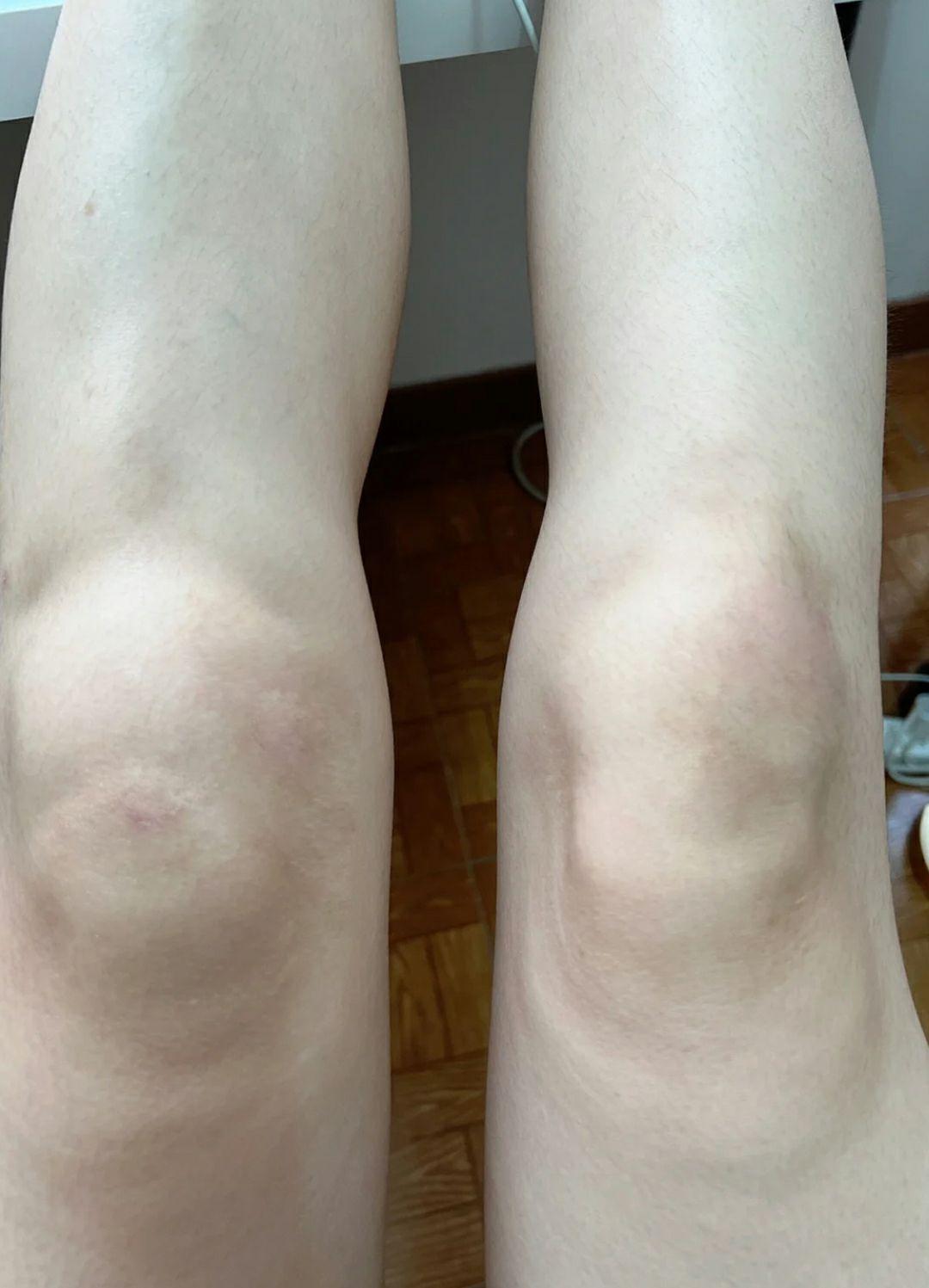 波棱盖磕马路牙子上喀秃噜皮了