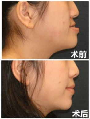 正颌手术的费用多少?