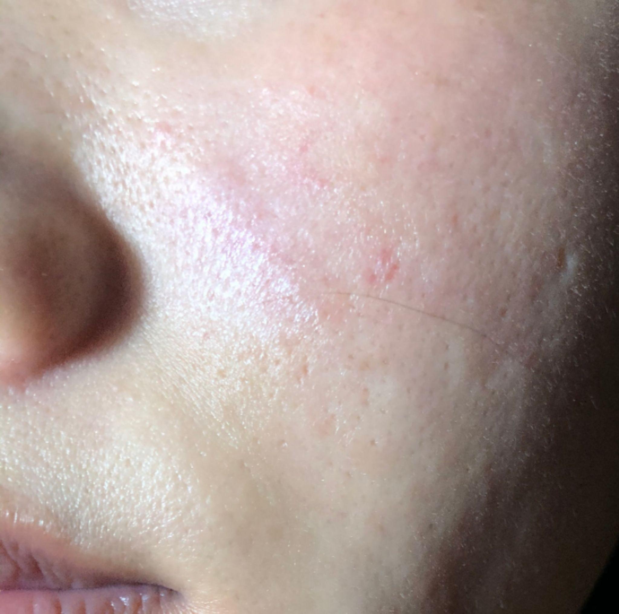 9年的疤痕了(我的一个朋友)如果动手术祛掉的话一般要花多少钱?