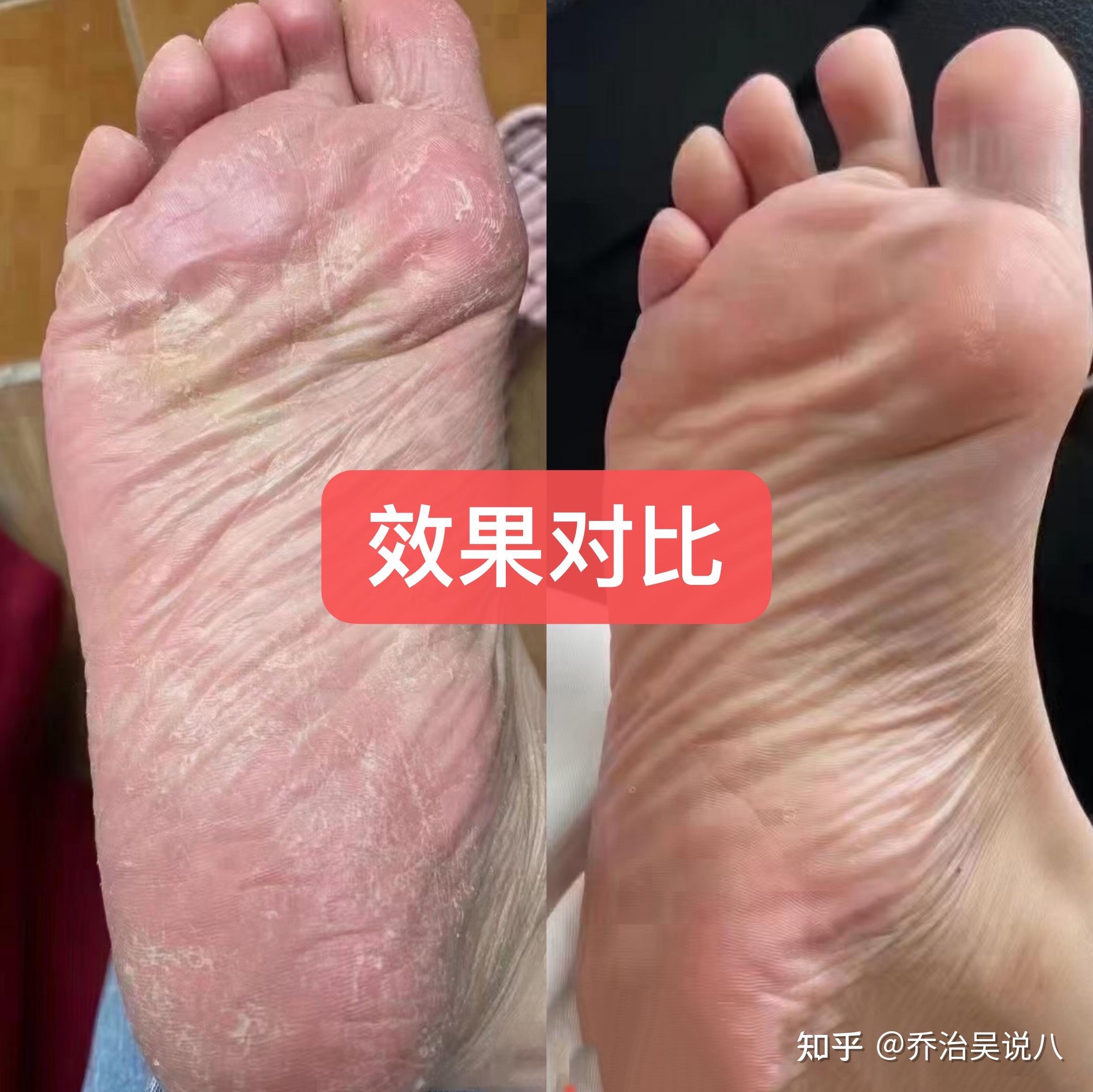 真菌引起的皮肤感染要如何治疗? - 知乎