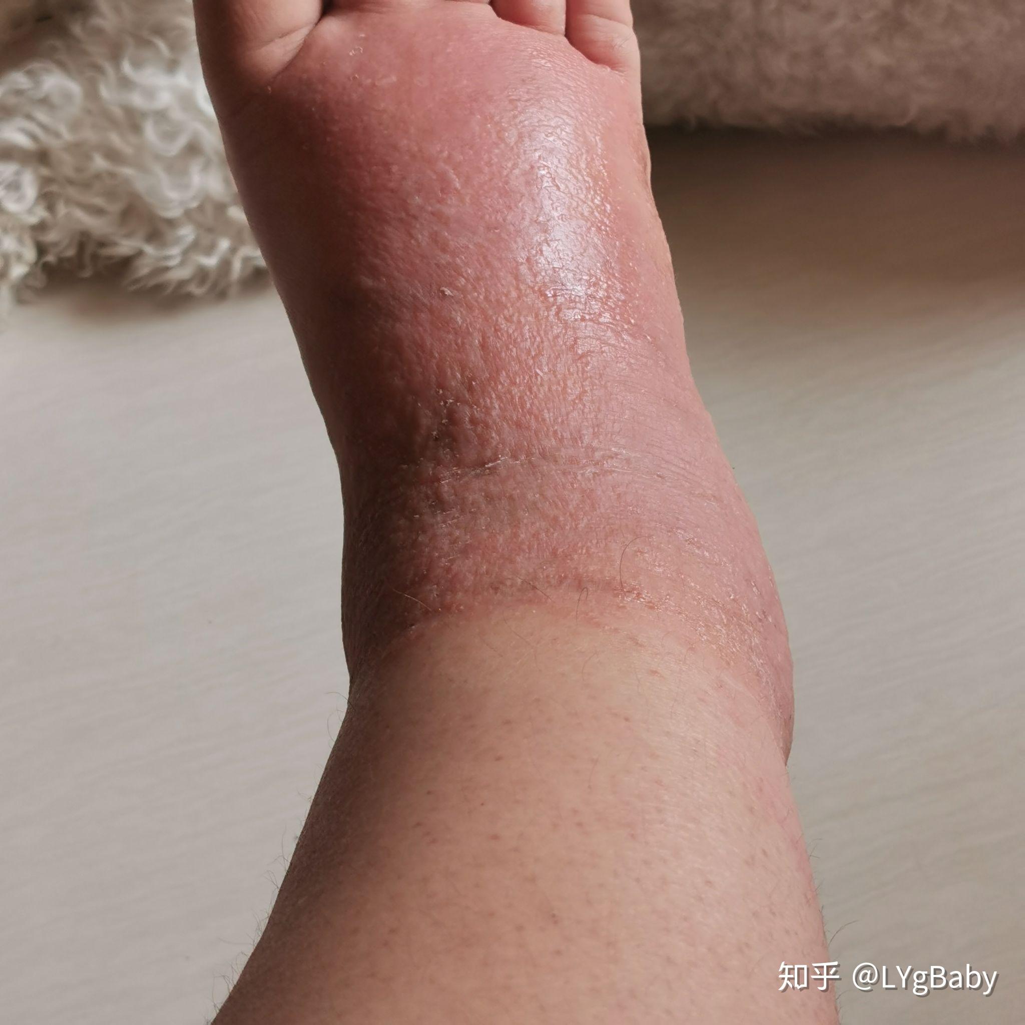 皮肤过敏起水泡怎么办