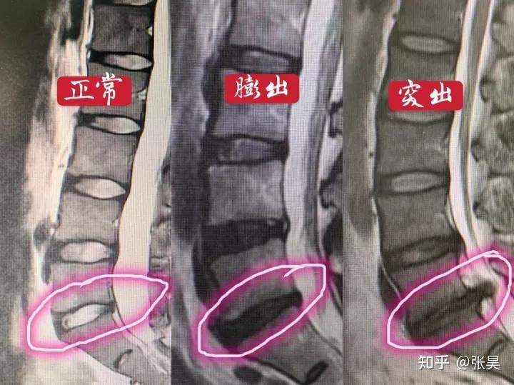 腰椎第四第五节膨出图片