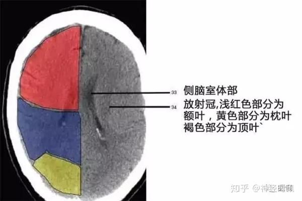解剖&影像 —— 颅脑CT解剖口诀及彩色解剖图 - 知乎