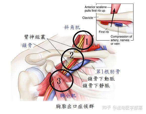 供應上肢的神經與血管都必須經過胸廓部位才會進入上肢,一旦這部位