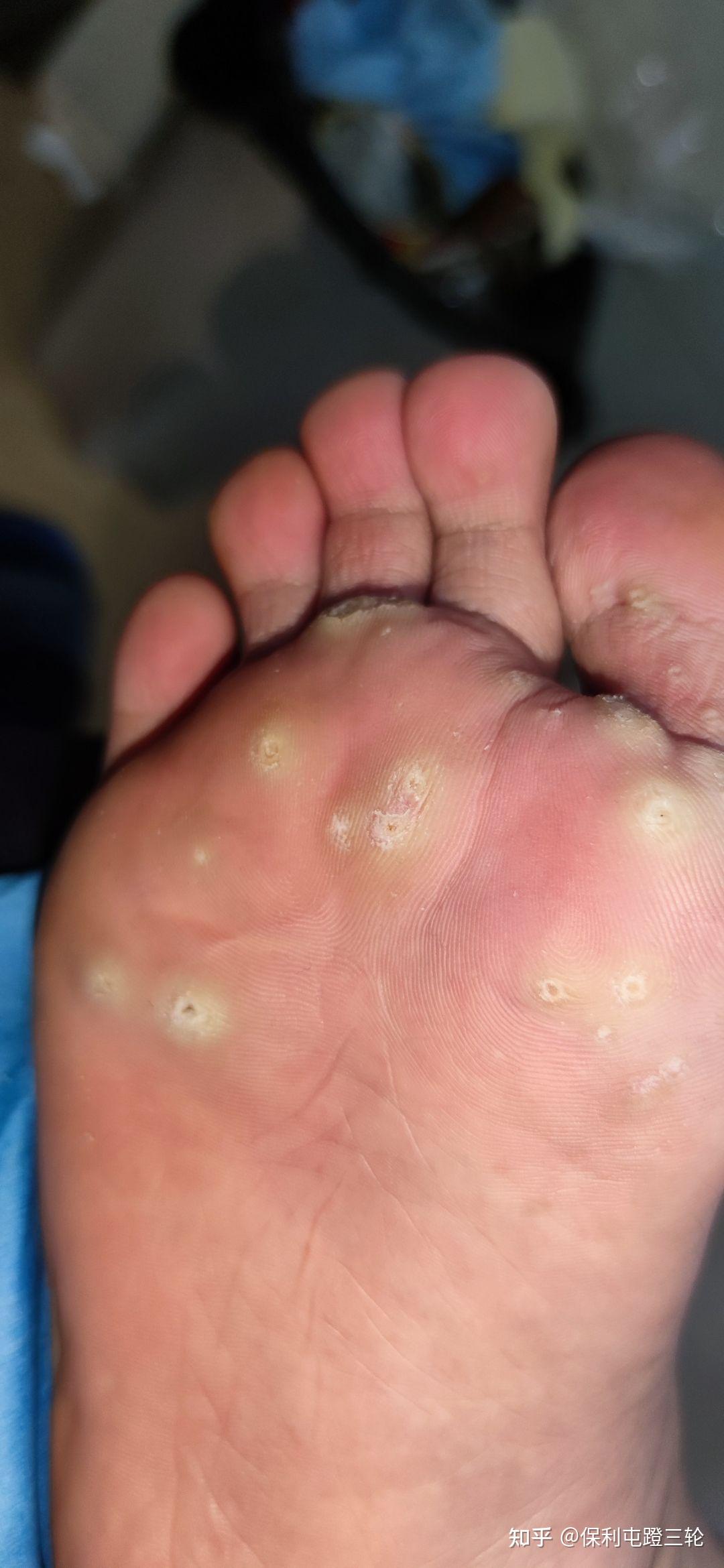 到底是趾疣点状角化还是鸡眼记录治疗过程