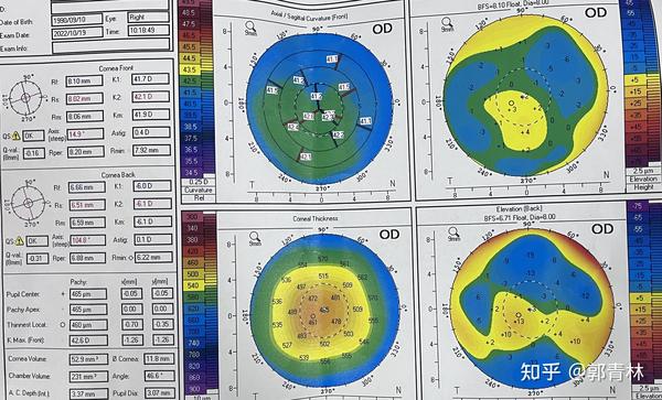 普通RGP解决早期圆锥案例1例 - 知乎