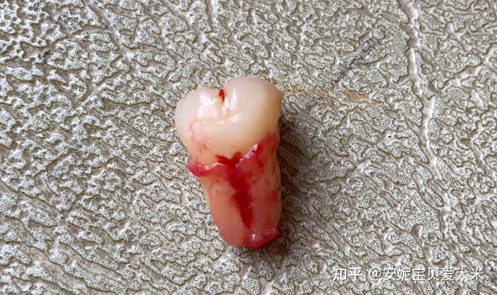 智齿牙胚图片
