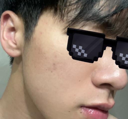 男生毛孔粗大皮肤很黑很粗糙怎么办