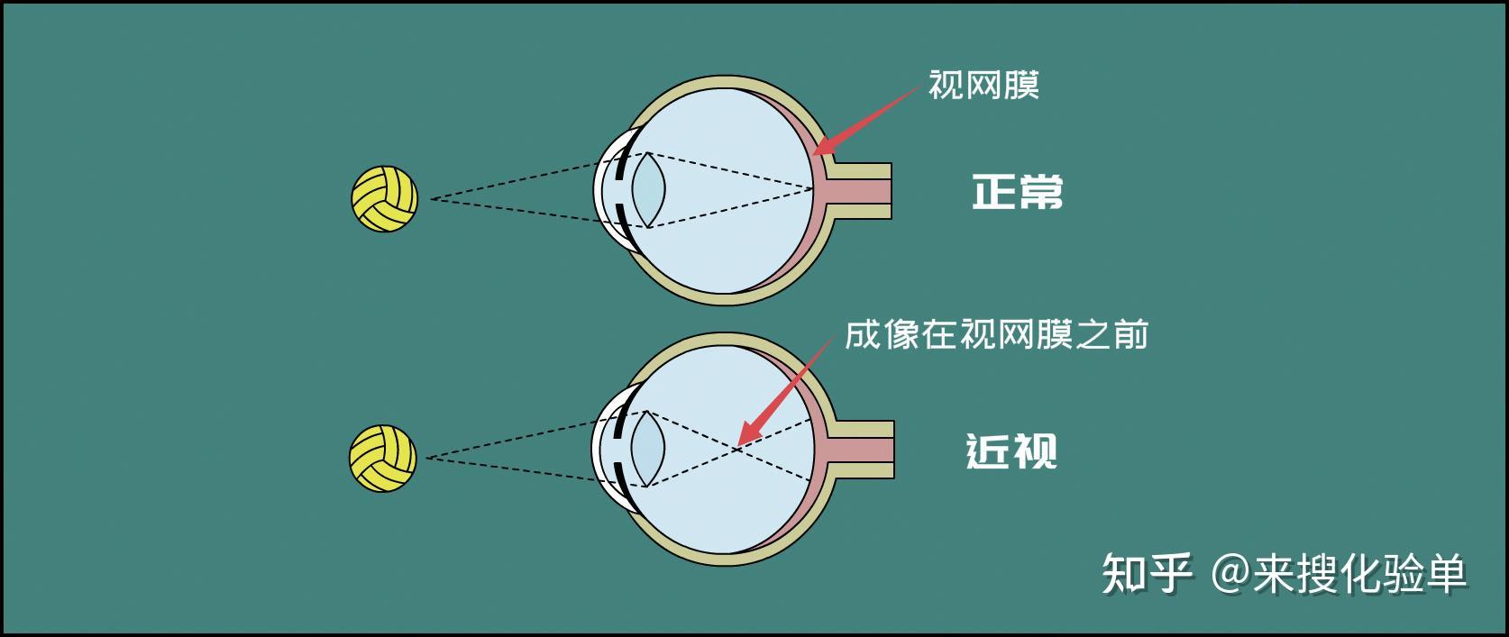 近视手术答疑时刻摘掉眼镜真的那么爽吗
