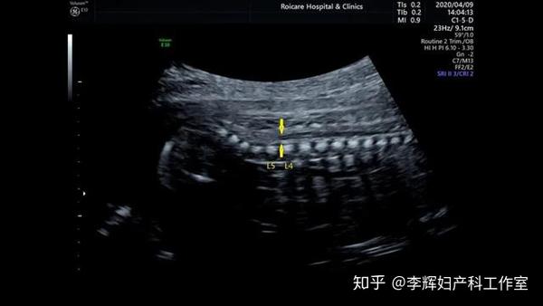 胎儿期发现脊髓圆锥位置低的临床指导
