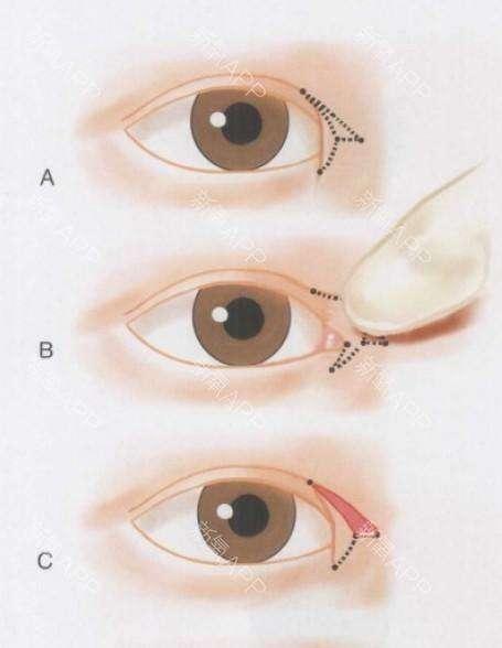 眼角内眦手术图片